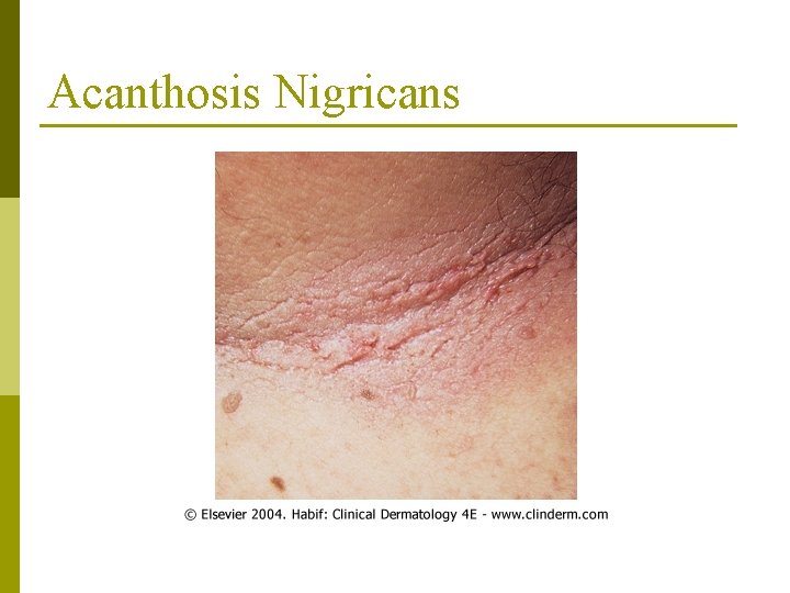 Acanthosis Nigricans 