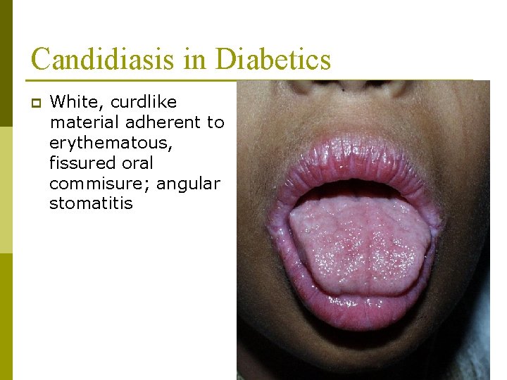 Candidiasis in Diabetics p White, curdlike material adherent to erythematous, fissured oral commisure; angular