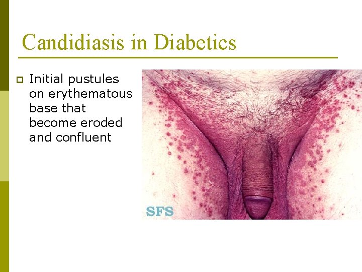 Candidiasis in Diabetics p Initial pustules on erythematous base that become eroded and confluent
