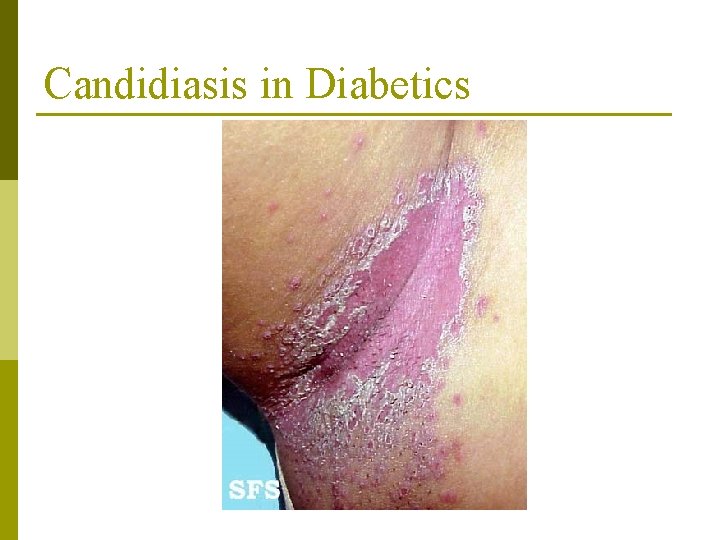 Candidiasis in Diabetics 