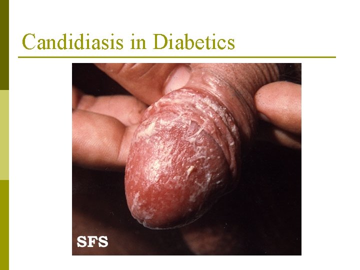 Candidiasis in Diabetics 