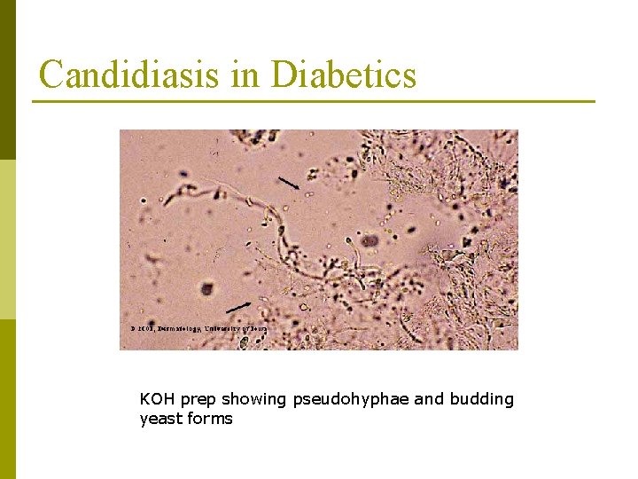 Candidiasis in Diabetics KOH prep showing pseudohyphae and budding yeast forms 
