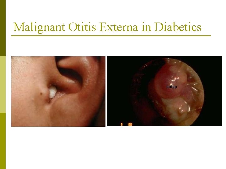 Malignant Otitis Externa in Diabetics 