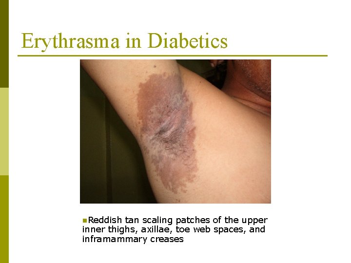 Erythrasma in Diabetics n. Reddish tan scaling patches of the upper inner thighs, axillae,