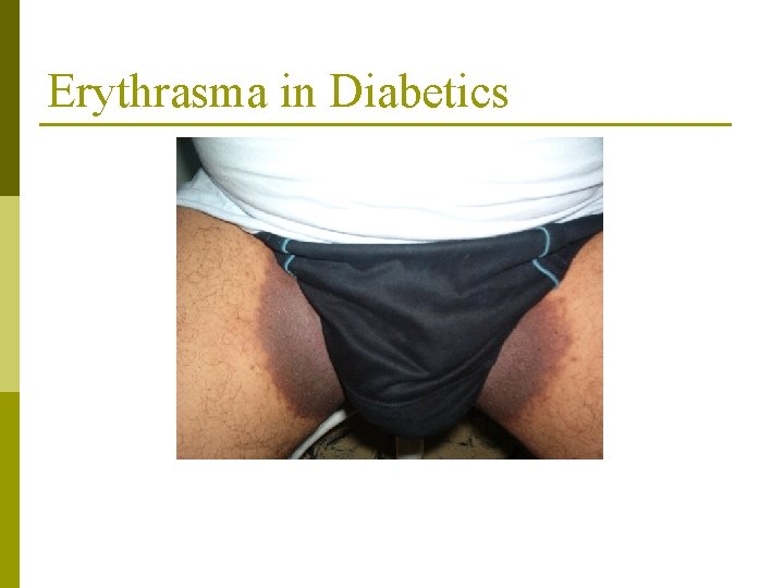 Erythrasma in Diabetics 
