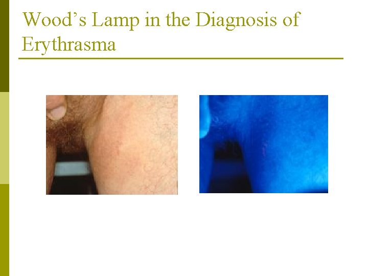 Wood’s Lamp in the Diagnosis of Erythrasma 