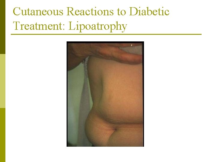Cutaneous Reactions to Diabetic Treatment: Lipoatrophy 