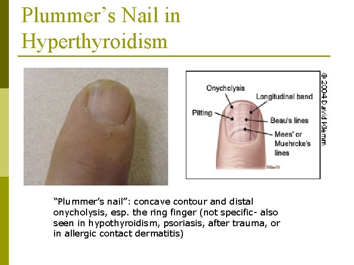 Plummer’s Nail in Hyperthyroidism “Plummer’s nail”: concave contour and distal onycholysis, esp. the ring