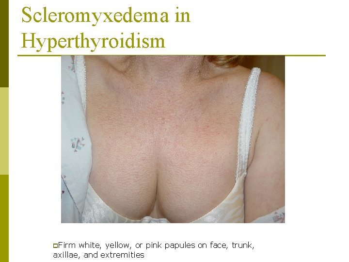 Scleromyxedema in Hyperthyroidism p. Firm white, yellow, or pink papules on face, trunk, axillae,