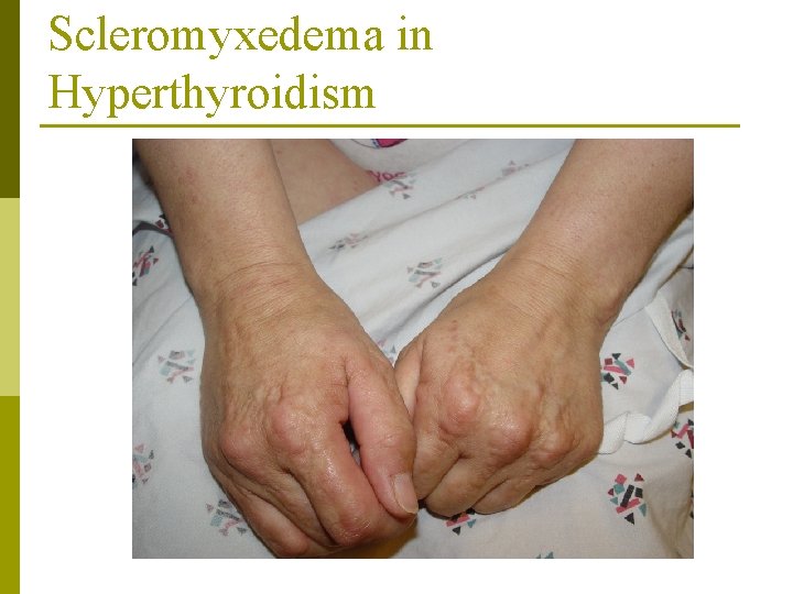 Scleromyxedema in Hyperthyroidism 