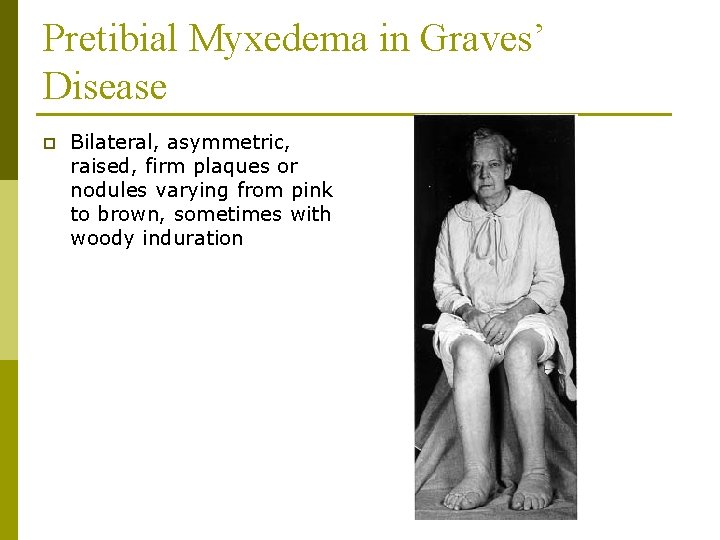 Pretibial Myxedema in Graves’ Disease p Bilateral, asymmetric, raised, firm plaques or nodules varying