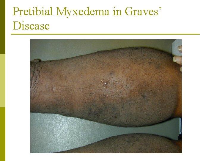 Pretibial Myxedema in Graves’ Disease 