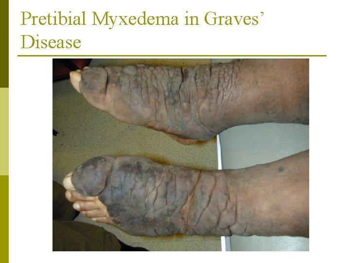 Pretibial Myxedema in Graves’ Disease 