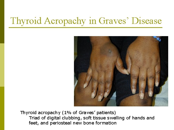 Thyroid Acropachy in Graves’ Disease Thyroid acropachy (1% of Graves’ patients) Triad of digital
