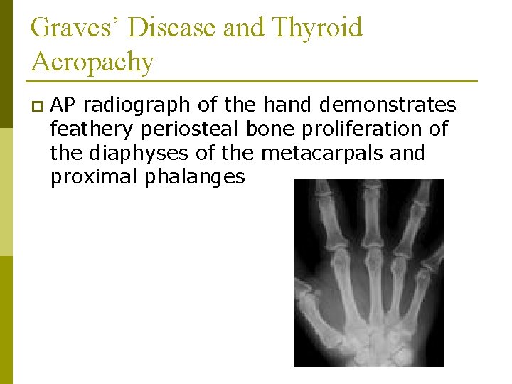 Graves’ Disease and Thyroid Acropachy p AP radiograph of the hand demonstrates feathery periosteal