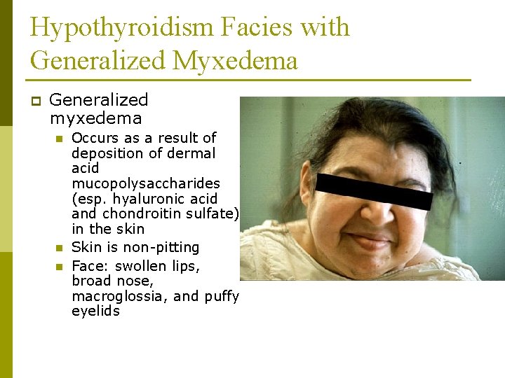 Hypothyroidism Facies with Generalized Myxedema p Generalized myxedema n n n Occurs as a