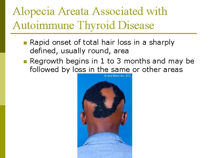 Alopecia Areata Associated with Autoimmune Thyroid Disease n n Rapid onset of total hair