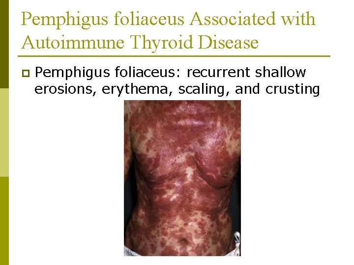 Pemphigus foliaceus Associated with Autoimmune Thyroid Disease p Pemphigus foliaceus: recurrent shallow erosions, erythema,