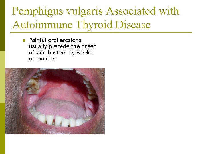 Pemphigus vulgaris Associated with Autoimmune Thyroid Disease n Painful oral erosions usually precede the