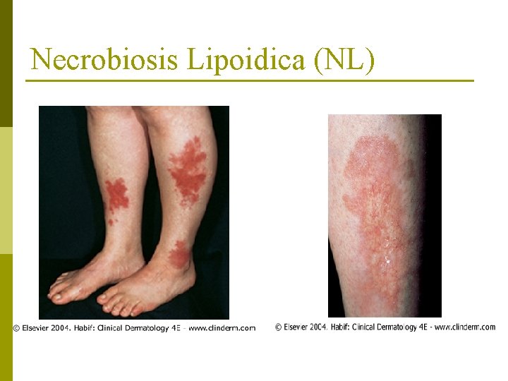 Necrobiosis Lipoidica (NL) 