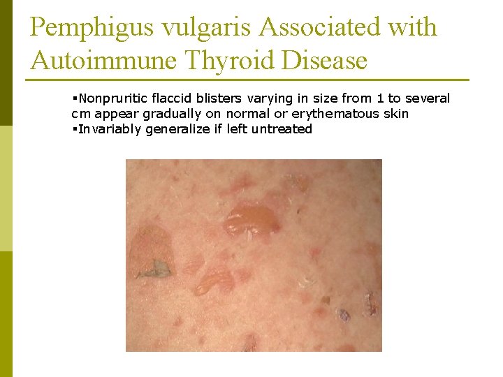 Pemphigus vulgaris Associated with Autoimmune Thyroid Disease §Nonpruritic flaccid blisters varying in size from