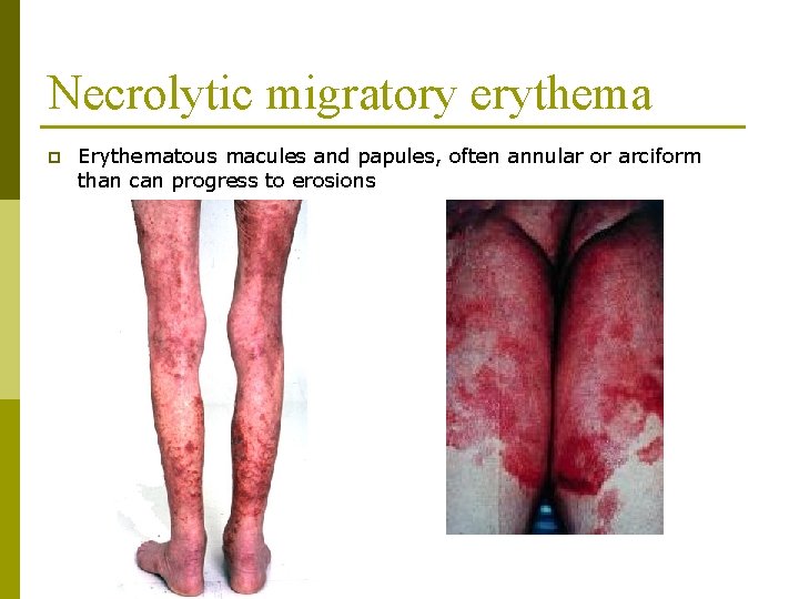 Necrolytic migratory erythema p Erythematous macules and papules, often annular or arciform than can