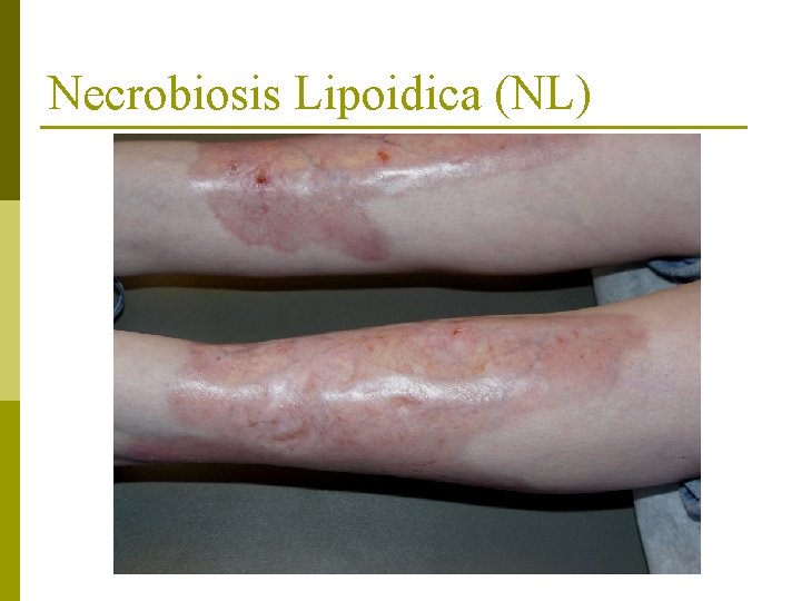 Necrobiosis Lipoidica (NL) 