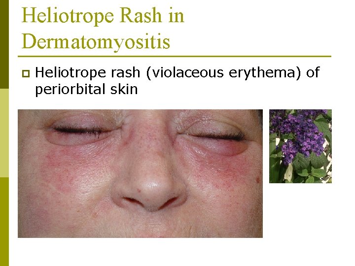 Heliotrope Rash in Dermatomyositis p Heliotrope rash (violaceous erythema) of periorbital skin 