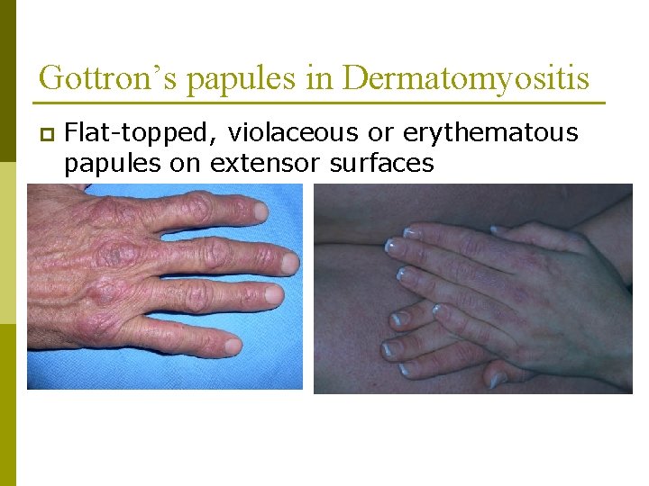 Gottron’s papules in Dermatomyositis p Flat-topped, violaceous or erythematous papules on extensor surfaces 