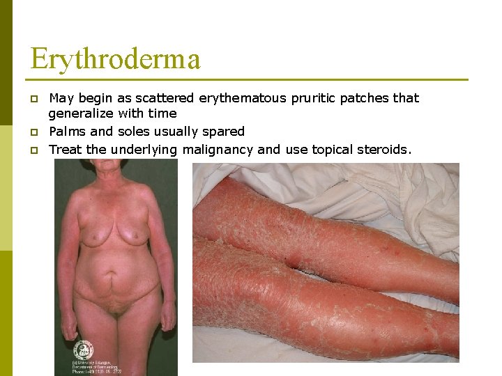 Erythroderma p p p May begin as scattered erythematous pruritic patches that generalize with