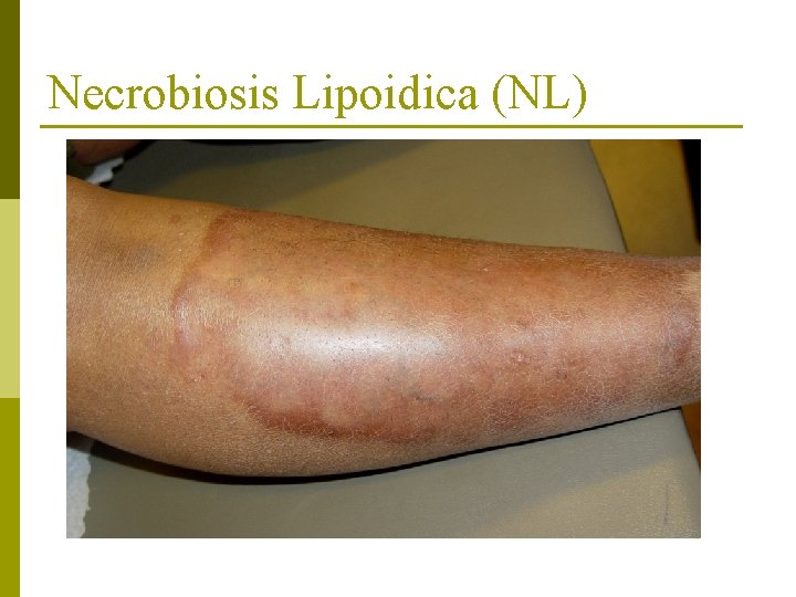 Necrobiosis Lipoidica (NL) 
