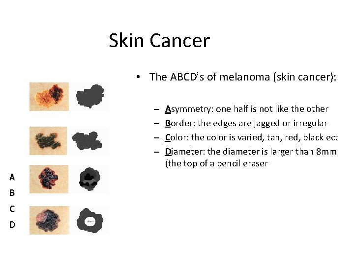 Skin Cancer • The ABCD’s of melanoma (skin cancer): – – A B C