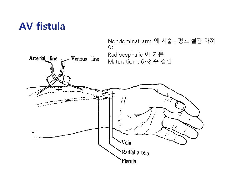 AV fistula Nondominat arm 에 시술 : 평소 혈관 아껴 야 Radiocephalic 이 기본