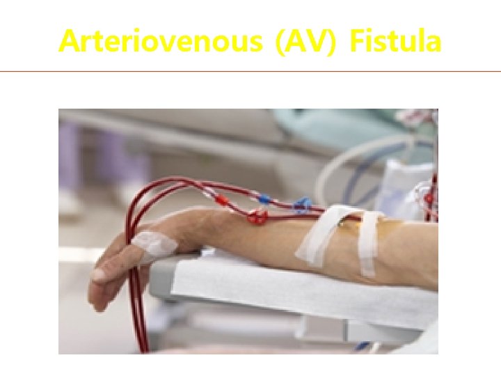 Arteriovenous (AV) Fistula 