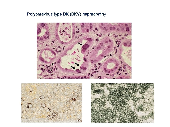 Polyomavirus type BK (BKV) nephropathy 