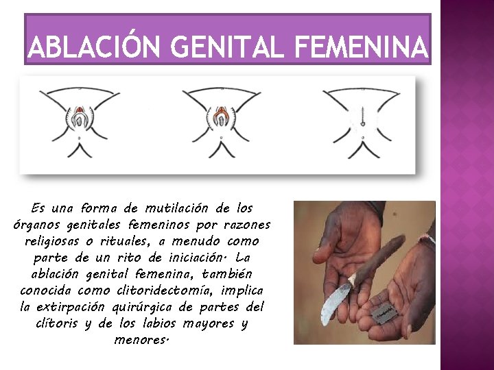 ABLACIÓN GENITAL FEMENINA Es una forma de mutilación de los órganos genitales femeninos por