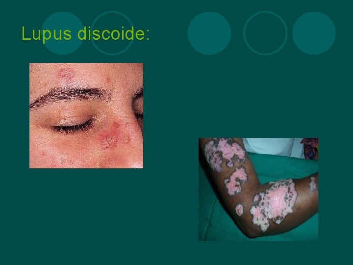 Lupus discoide: 