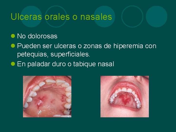 Ulceras orales o nasales l No dolorosas l Pueden ser ulceras o zonas de