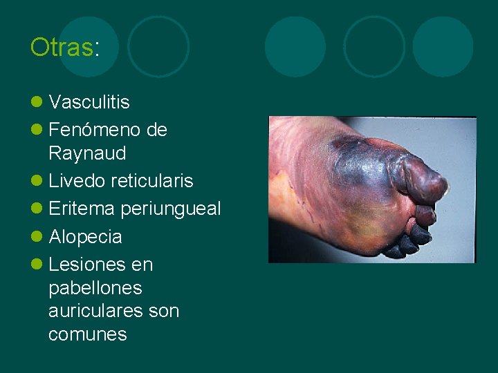 Otras: l Vasculitis l Fenómeno de Raynaud l Livedo reticularis l Eritema periungueal l