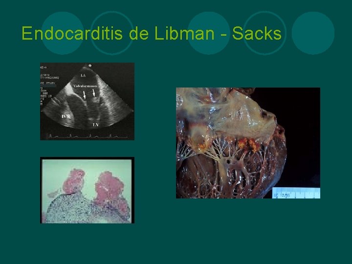 Endocarditis de Libman - Sacks 