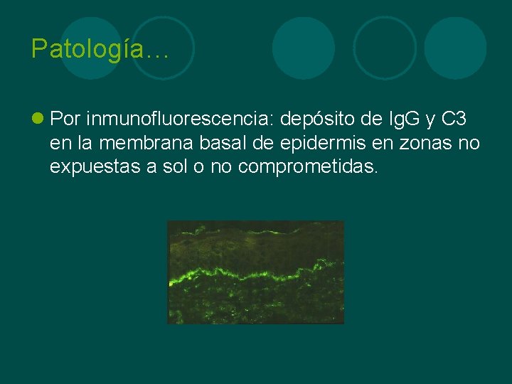 Patología… l Por inmunofluorescencia: depósito de Ig. G y C 3 en la membrana