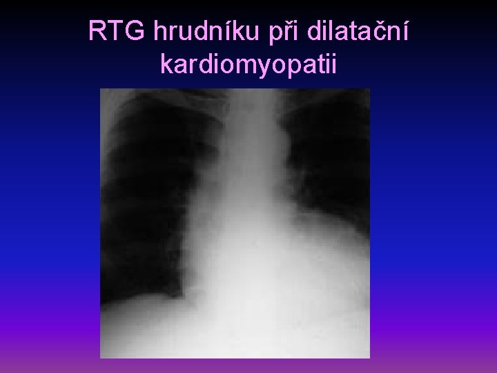 RTG hrudníku při dilatační kardiomyopatii 