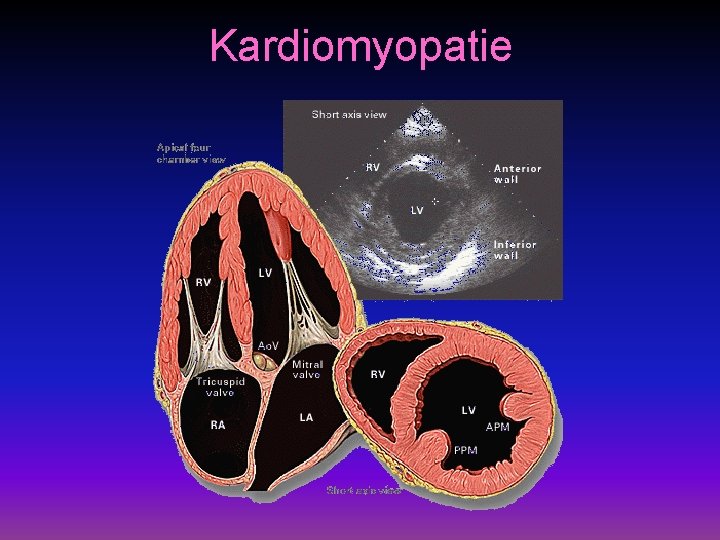 Kardiomyopatie 