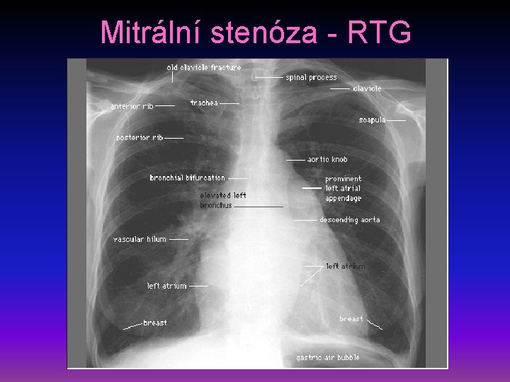 Mitrální stenóza - RTG 