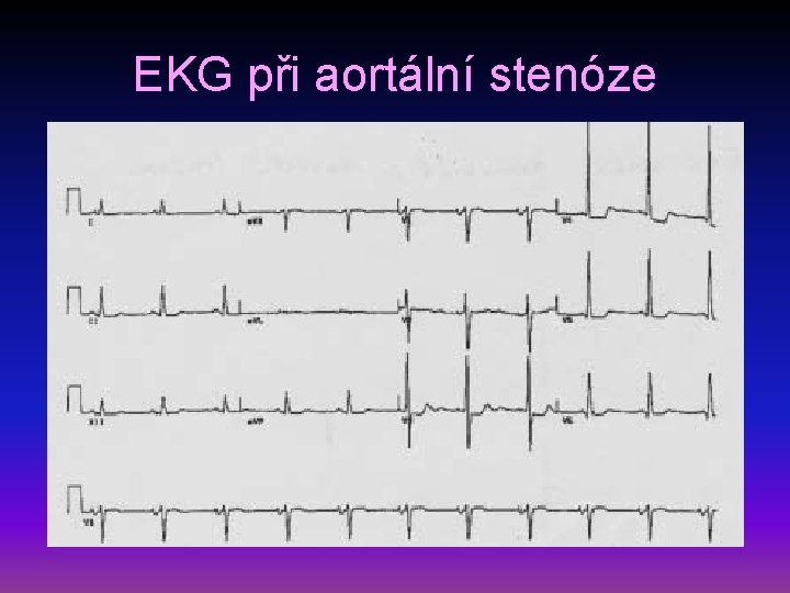 EKG při aortální stenóze 