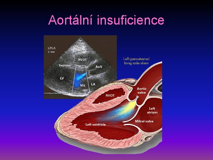 Aortální insuficience 
