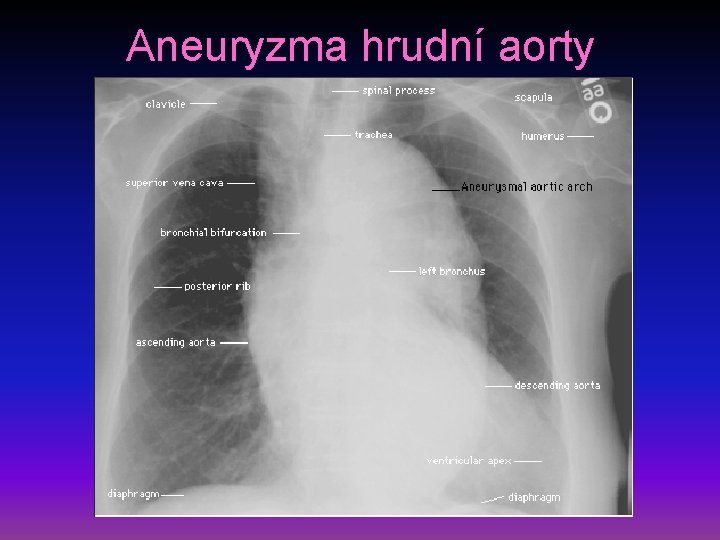 Aneuryzma hrudní aorty 