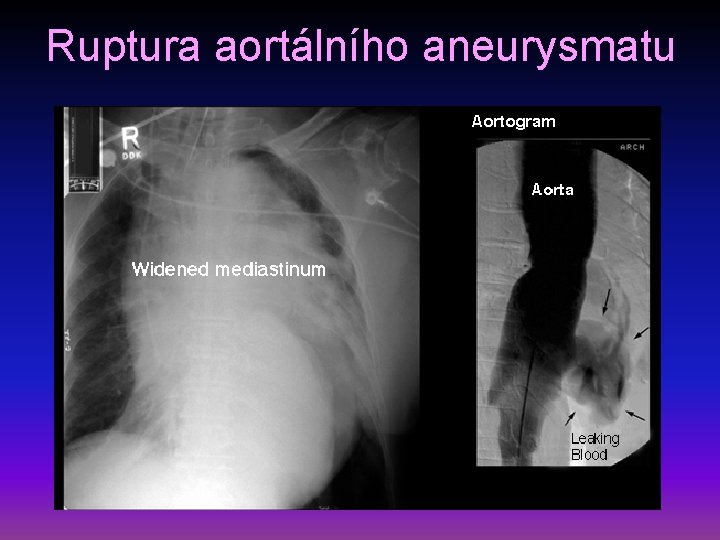 Ruptura aortálního aneurysmatu 