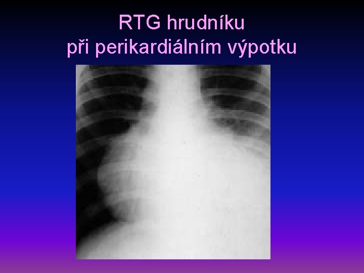 RTG hrudníku při perikardiálním výpotku 