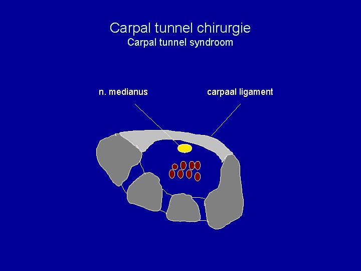 Carpal tunnel chirurgie Carpal tunnel syndroom n. medianus carpaal ligament 